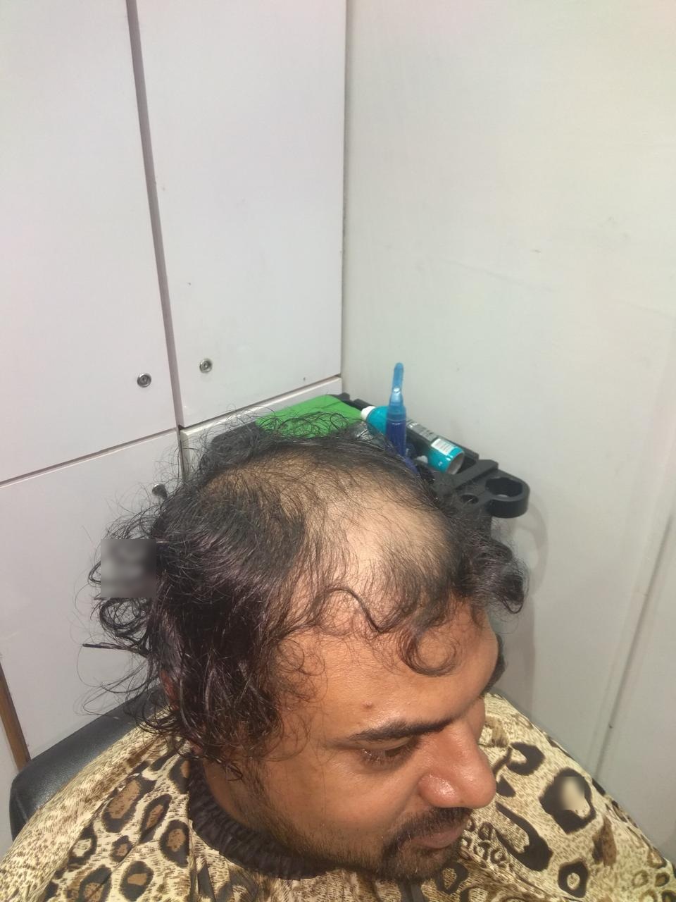 Hair Bonding for Men